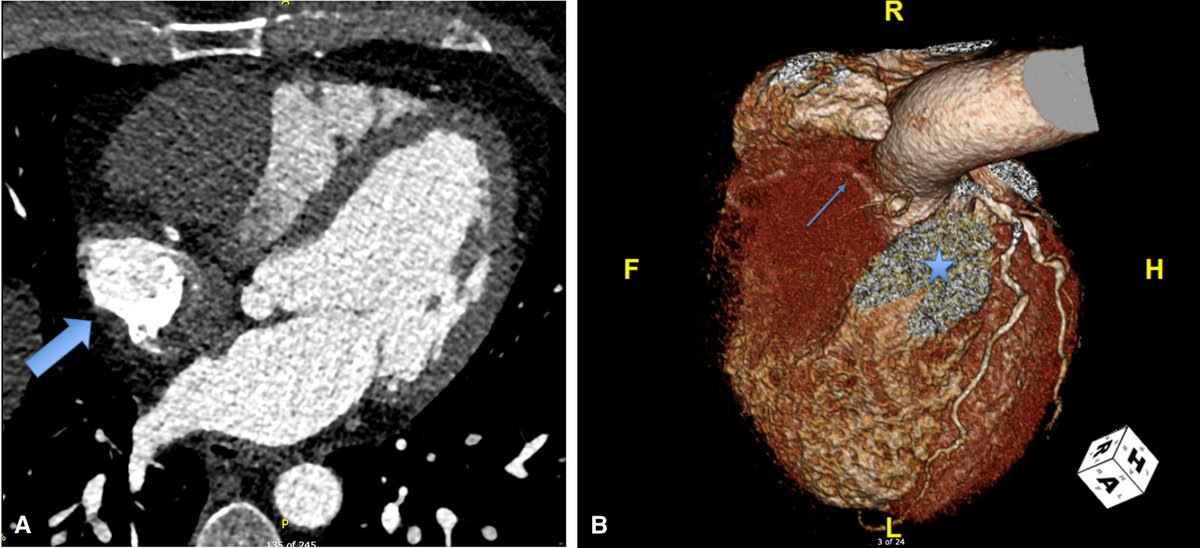 AATSHQ's tweet image. Recently published case report: Successful resection and reconstruction in a rare adult right ventricular #cardiac fibroma. Read the case presentation and surgical technique now in #JTCVS Techniques: doi.org/10.1016/j.xjtc…