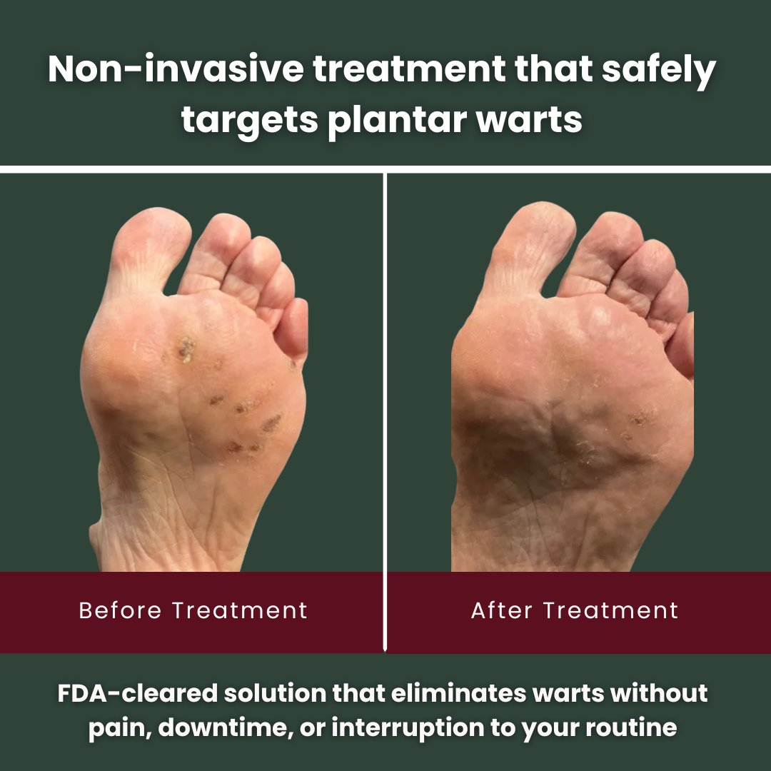 drtulifau's tweet image. 👣 Plantar warts? 

Treat them fast with Swift Therapy ⚡️ safe, non-invasive, no downtime, and effective even for stubborn cases.

Step back into pain-free feet 🌿🦶

#PlantarWarts #FootHealth #WartTreatment #SwiftTherapy #PainFreeFeet #AdvancedPodiatry #HealthyFeet