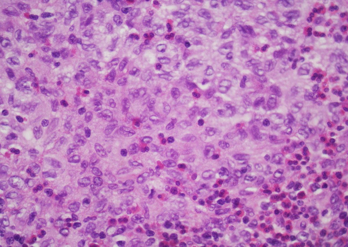 GuannanTiffany's tweet image. 🧩 Bladder riddle

Unusual location.
Think of something more common in children.
What’s the diagnosis? 🤔

#DxMindMap #BladderTumor #GUPath #PathTwitter