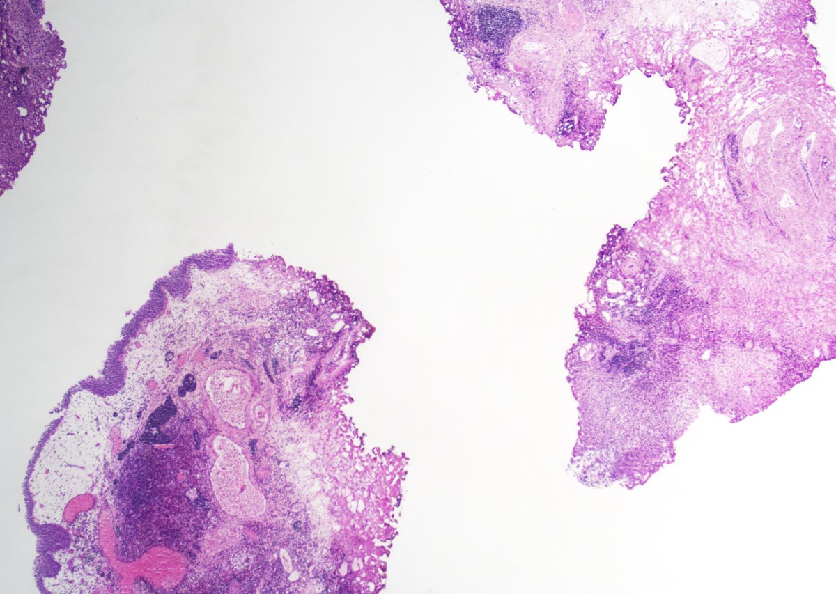 GuannanTiffany's tweet image. 🧩 Bladder riddle

Unusual location.
Think of something more common in children.
What’s the diagnosis? 🤔

#DxMindMap #BladderTumor #GUPath #PathTwitter