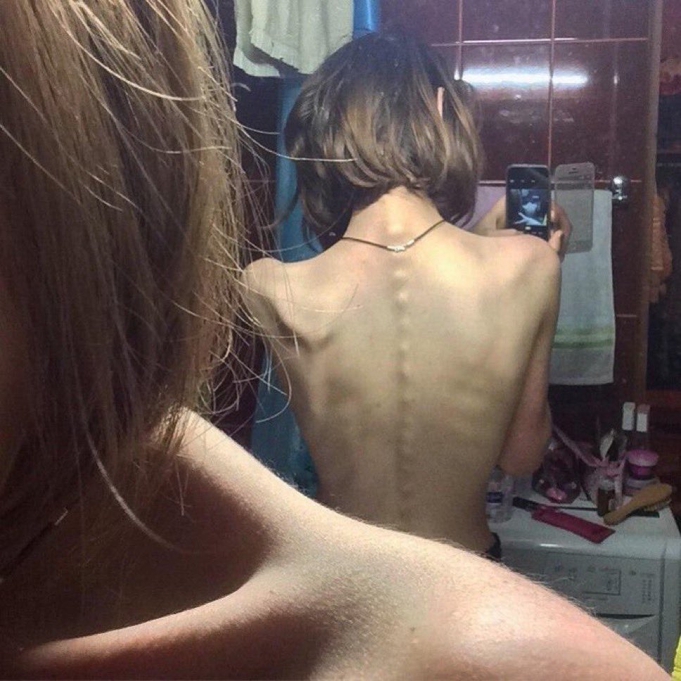 catvomitz's tweet image. #edtwt #bodycheck #thinspo
#bonespo #discord #eatingdisorser
#anorexia #tumblr #bulimia #relatable
#nsfwtwtًً 
JOIN THIS SERVER IF UR MENTALLY ILL , TOXIC , CUTE AND SKINNY, DISORDERED , 14+!! 
discord.gg/vomit