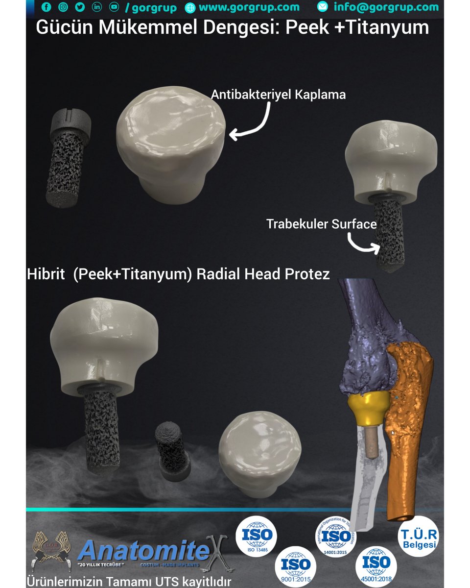 gorgrup's tweet image. We are proud of every stage of this patient-specific solution designed for a Mason type 3 (completely comminuted) radial head fracture. This prosthesis reflects the cutting-edge technology we have achieved at the intersection of medicine and engineering:
#3d #radialhead  #medical