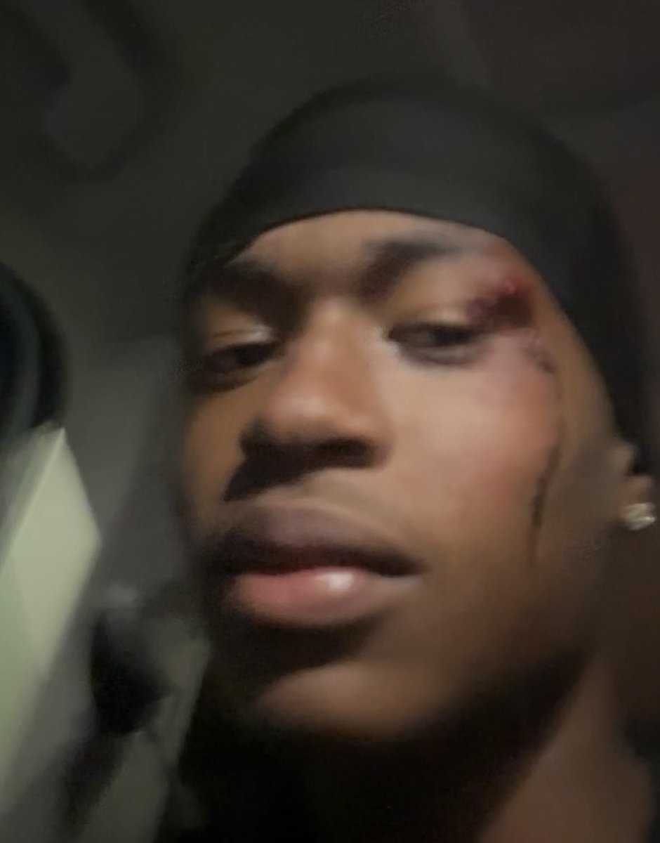 T2Nicholson's tweet photo. Earned 5 stitches playing football at my track meet 🤣 https://t.co/qpvevfp2SW