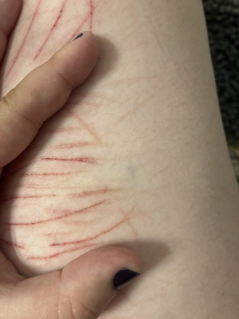 griffst3rs's tweet image. would it be safe to cut this, i cant tell if its a vein or a bruise but i want to cut it either way #shtwt #shedtwt #slittwt
