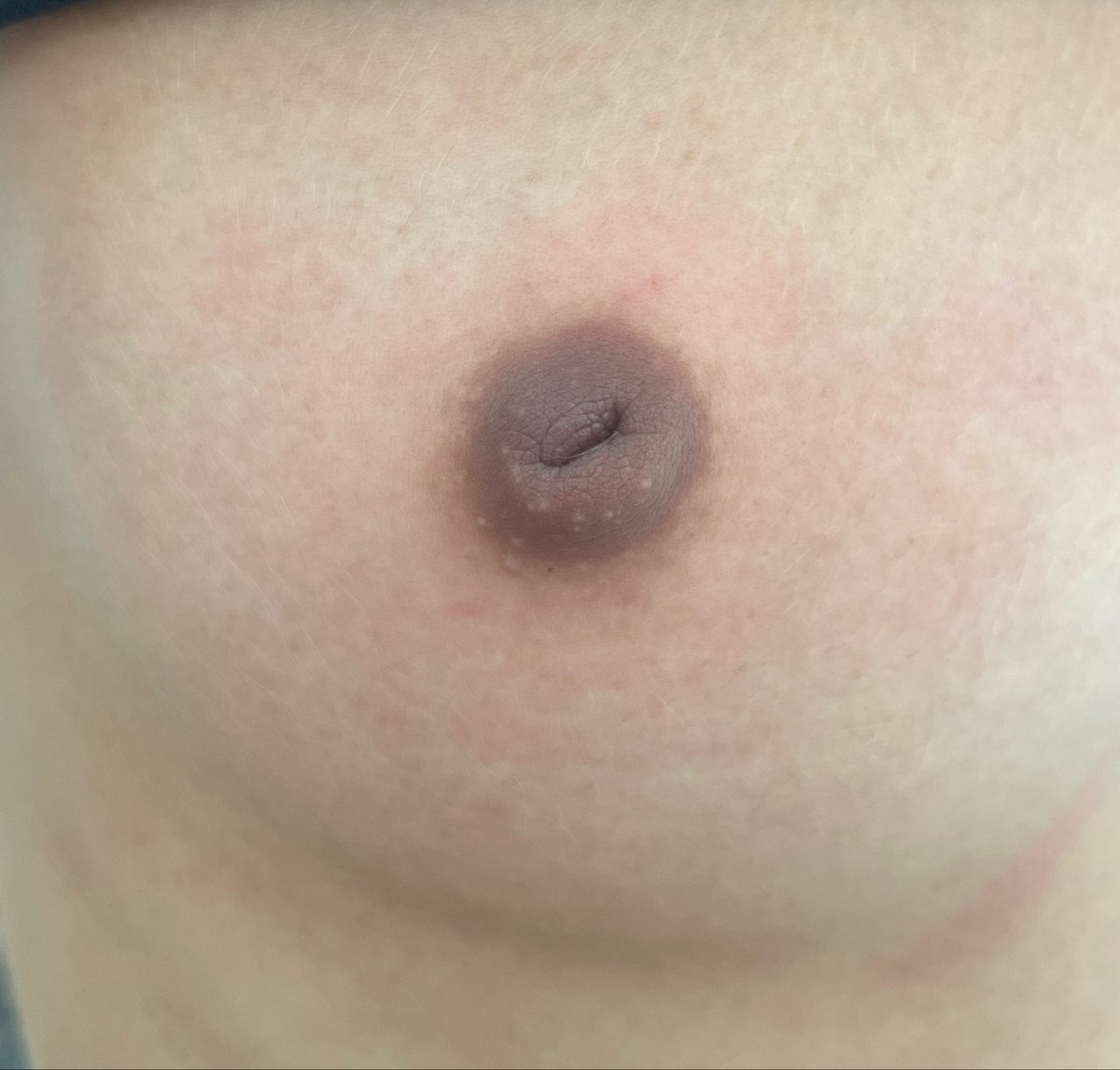 botelhopiercing's tweet photo. Ex Mamilo Invertido • Procedimento seguro e responsável • Atendimento em Nova Iguaçu ou Pavuna. https://t.co/Rxs4kV2CdQ