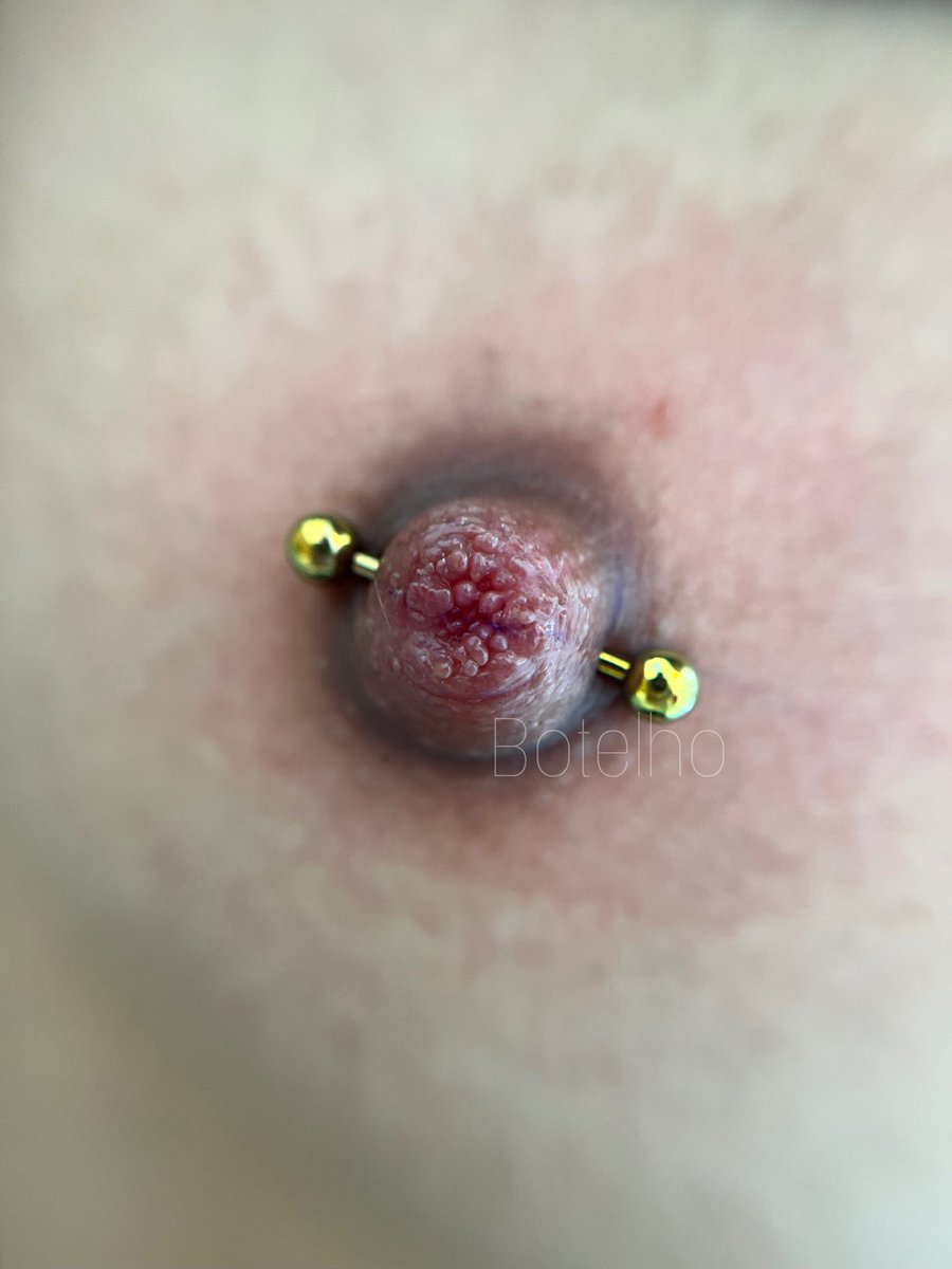 botelhopiercing's tweet photo. Ex Mamilo Invertido • Procedimento seguro e responsável • Atendimento em Nova Iguaçu ou Pavuna. https://t.co/Rxs4kV2CdQ