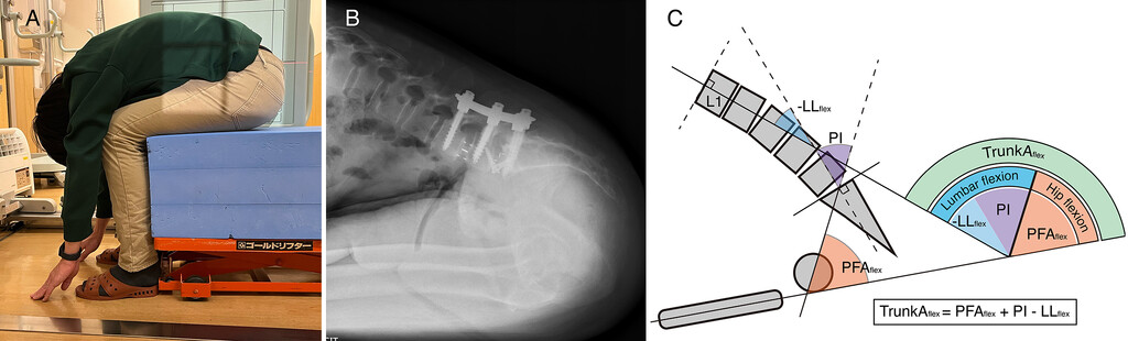 TheJNS's tweet image. #OnlineFirst: Role of hip and lumbar flexion angles in stiffness-related disabilities with activities of daily living after lumbar spine surgery.

thejns.org/spine/view/jou…