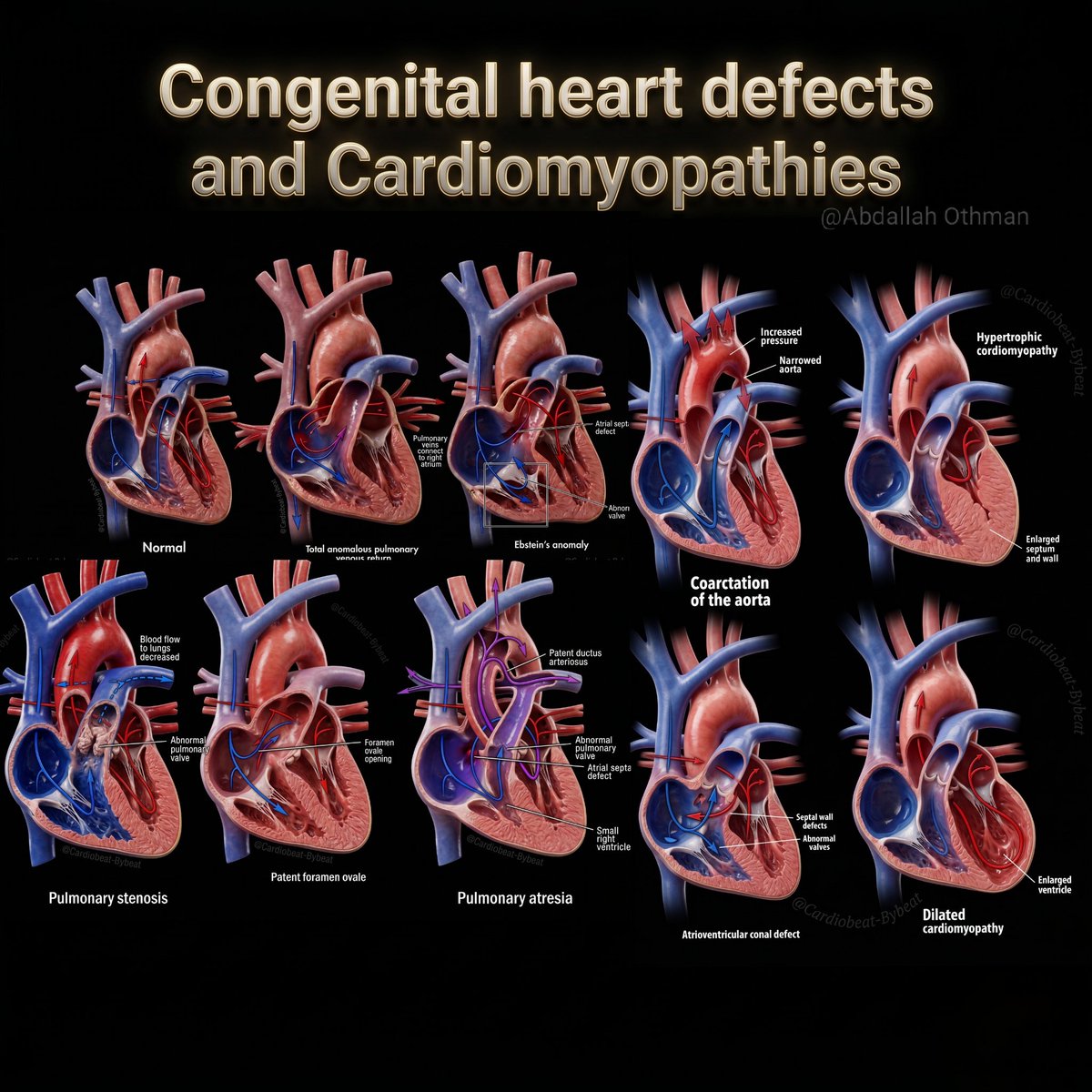 CardioBeat_'s tweet image. facebook.com/share/p/1CnVCx…
🫀 Congenital Heart Defects and Cardiomyopathies clear visual guide for medical students. 🤗 
#CongenitalHeartDisease #Cardiology #MedicalEducation #Cardiomyopathy #HeartDefects 🧠❤️