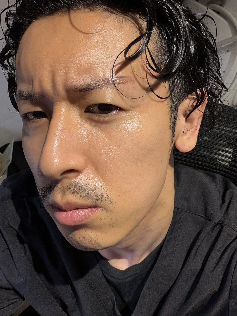 dr_fukky's tweet photo. 僕が実際に受けた「ディスカバリーピコプラス」での毛穴・ニキビ跡治療、当日と1週間後の経過です🏥
レーザー治療は痛みが強く、効果的な出力まで上げられないことも多いです。そこで、弱い出力で何度も回数を重ねるのではなく、睡眠麻酔を使って寝ている間に最適な出力まで上げて照射！ダウンタイムは出ますが、最短で確実に肌を綺麗にしたい方に本気でおすすめです。
#睡眠麻酔