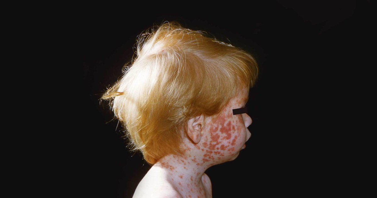 Russia eased vaccination standards when diphtheria seemed beaten. 157,000 infections. 5,000 dead. Japan dropped mandates after a trust collapse. Rubella came back. Babies born blind and deaf. Nigeria boycotted polio shots. The virus paralyzed 2,500 children and spread to 20