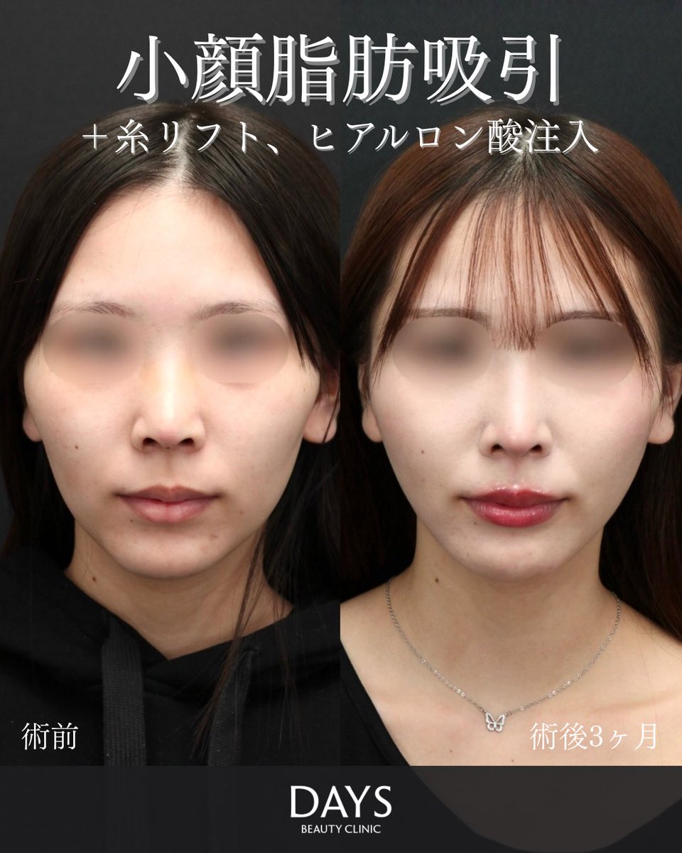 小顔整形 山野祐 tweet media