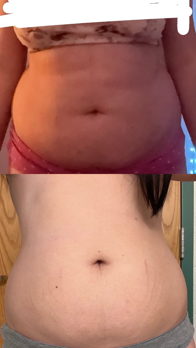 lolcl5r's tweet image. tw: bc 

i can’t get rid of my stubborn belly fat no matter how much i seem to lose. i’ve lost 30lbs, even when i was at my lowest (105lbs) i still had stomach fat. any advice? 

#edtwt #ana #weightloss #progresspics