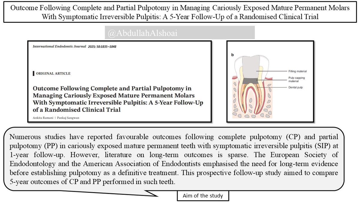 AbdullahAlshoai's tweet photo. #Dental_updates 

Outcome Following Complete and Partial Pulpotomy in Managing Cariously Exposed Mature Permanent Molars With Symptomatic Irreversible Pulpitis: A 5-Year Follow-Up of a Randomised Clinical Trial

International Endodontic Journal, 2025; 58:1835–1848 https://t.co/I0I4lFvwaA