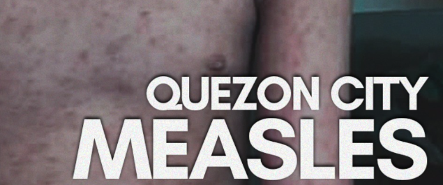 bactiman63's tweet image. #Philippines: #Measles in #QuezonCity open.substack.com/pub/outbreakne…
