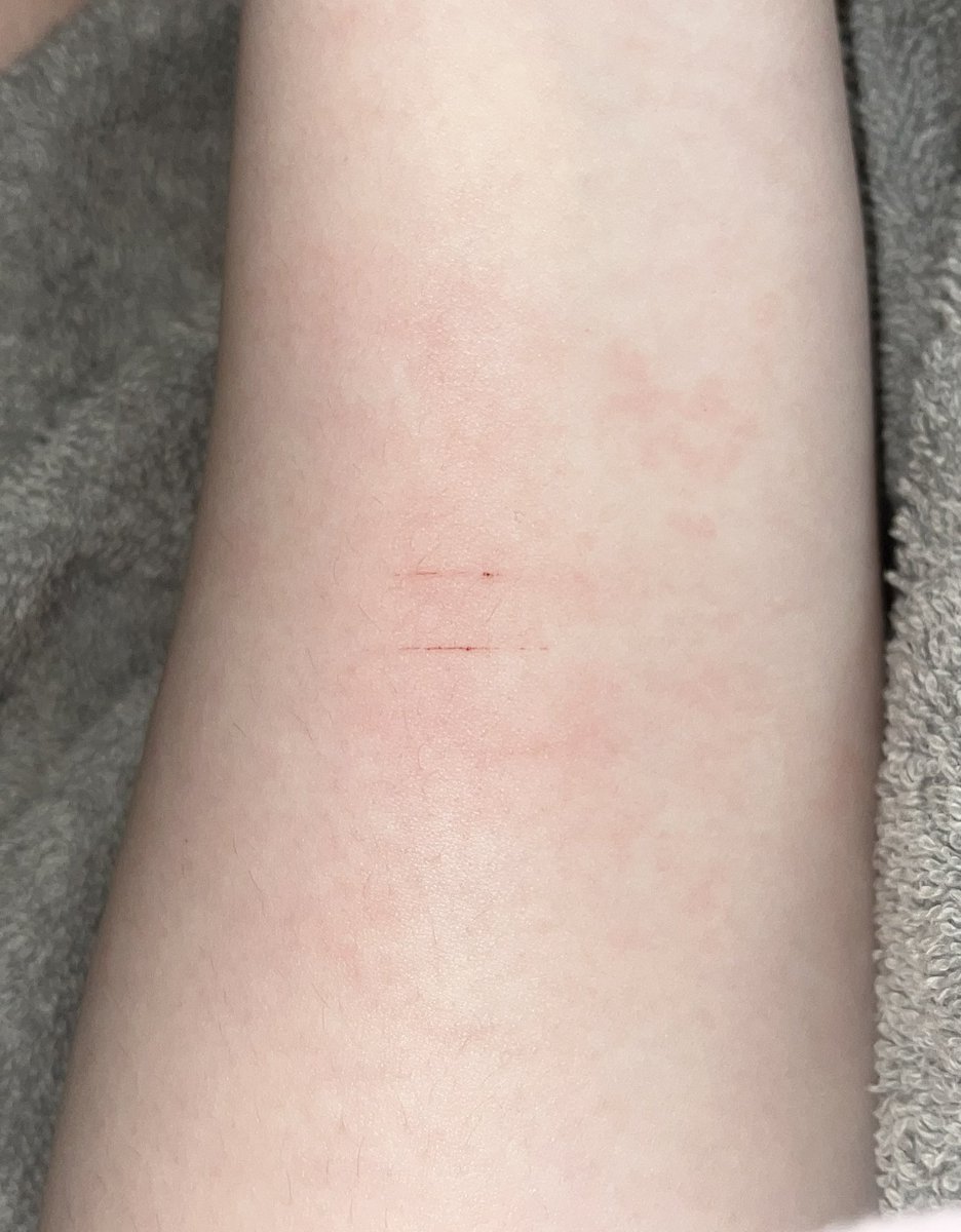 bruisedpupy's tweet image. EEEEKKK!!!!! My ass camera made it look bad-

#shtwt #slittwt #cutting #cutspo