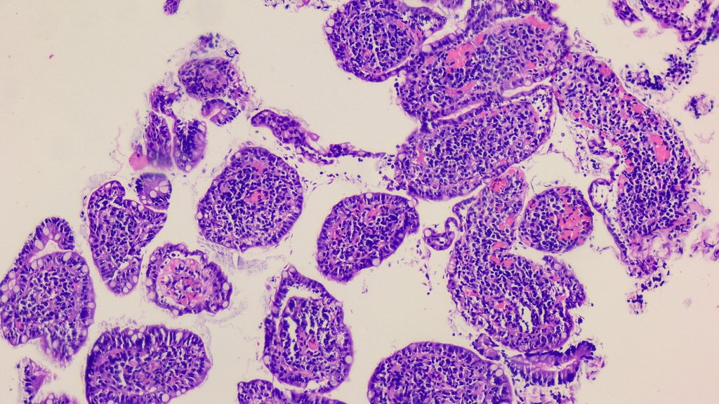 shalinirkr21's tweet image. 22 Y/M with bouts of loose stools + vomiting; labelled as “anxiety disorder” and sent on his way.
Slide said, “look closer.” 👀

Turns out… not every case is in your head, some just know how to “stick around” without being seen.

Ileal biopsy done; diagnosis❓

#GIPath #PathX