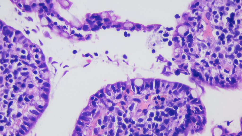 shalinirkr21's tweet image. 22 Y/M with bouts of loose stools + vomiting; labelled as “anxiety disorder” and sent on his way.
Slide said, “look closer.” 👀

Turns out… not every case is in your head, some just know how to “stick around” without being seen.

Ileal biopsy done; diagnosis❓

#GIPath #PathX