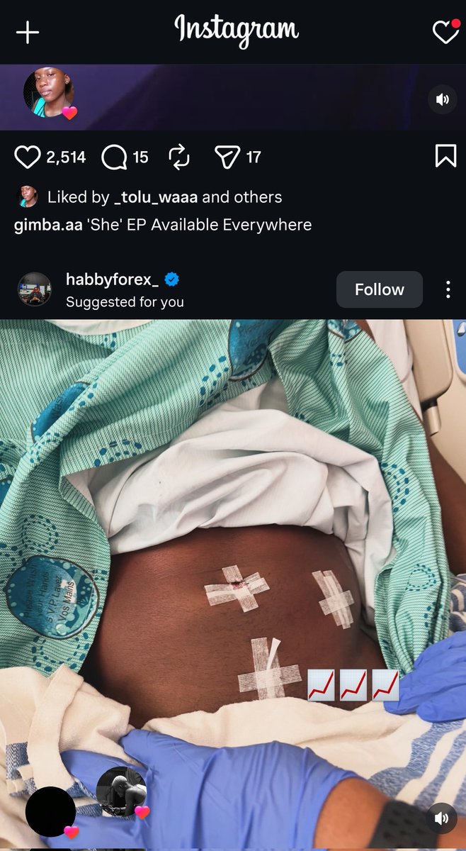 After losing alot of money on forex trading Habby forex sold his Left Kidney so he could able to raise funds to trade again now the right Kidney is still on risk as we speak now The Doctor said he can di@ any moment from now