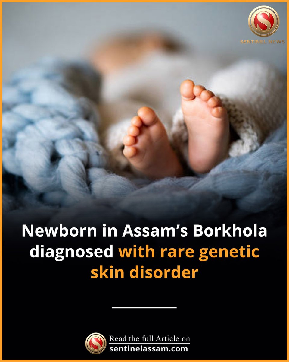 Sentinel_Assam's tweet image. A newborn in Borkhola area of Assam’s Cachar district has been diagnosed with the rare genetic condition Harlequin ichthyosis, drawing attention in the region. 

#TheSEntinel #Newborn #Rare