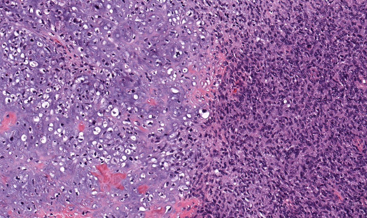 JMGardnerMD's tweet image. 60 yo M w "cyst" on face (hint: it's not a cyst!). No connection to bone. Diagnosis? 
Answer ✅ youtube.com/watch?v=JyB18Q… 
Digital slide: kikoxp.com/posts/11795
Stains: kikoxp.com/posts/11806
#pathology #pathologists #pathTwitter #dermpath #dermatology #bstpath #dermtwitter