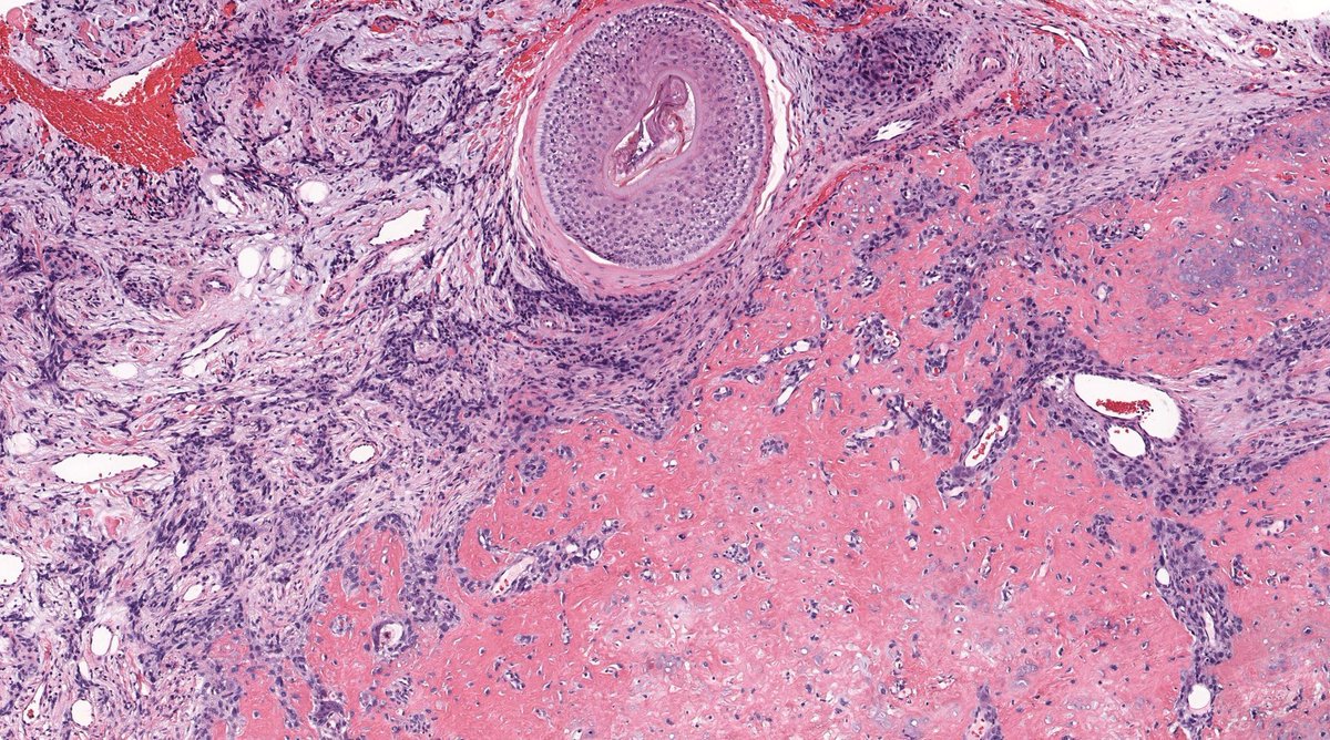 JMGardnerMD's tweet image. 60 yo M w "cyst" on face (hint: it's not a cyst!). No connection to bone. Diagnosis? 
Answer ✅ youtube.com/watch?v=JyB18Q… 
Digital slide: kikoxp.com/posts/11795
Stains: kikoxp.com/posts/11806
#pathology #pathologists #pathTwitter #dermpath #dermatology #bstpath #dermtwitter