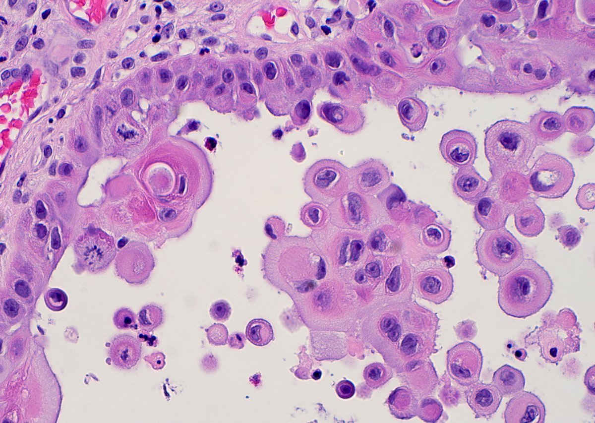 JMGardnerMD's tweet image. Skin biopsy from sun damaged skin in elderly man. Diagnosis? Answer youtu.be/1gPZDfMabGg #pathology #pathologists #pathTwitter #dermpath #dermatology #dermatologia #dermtwitter