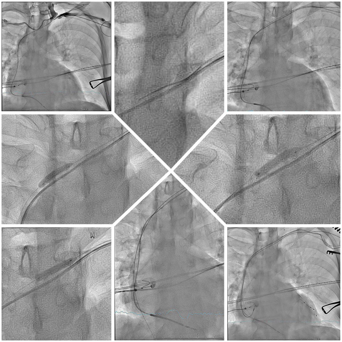 ipetemil's tweet image. Total venous occlusion → not a dead end.

ICD→CRT-D via venoplasty 🪡
Caravel MC · Pilot50 → ConfianzaPro12 · 4mm OTW ✅

w/ JMalakos @Kariki_O @athsaplaouras @SteliosDragasis @koskinastavrina @K_Letsas @MEfraimidis

#CIED #Venoplasty #CRTupgrade #EPeeps #OnassisHospital