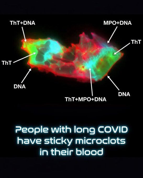 A groundbreaking study has pinpointed a microscopic culprit behind the debilitating fatigue, brain fog, and other persistent symptoms of long COVID: abnormal, sticky microclots embedded with neutrophil extracellular traps (NETs) in patients' blood.

These microclots—tiny