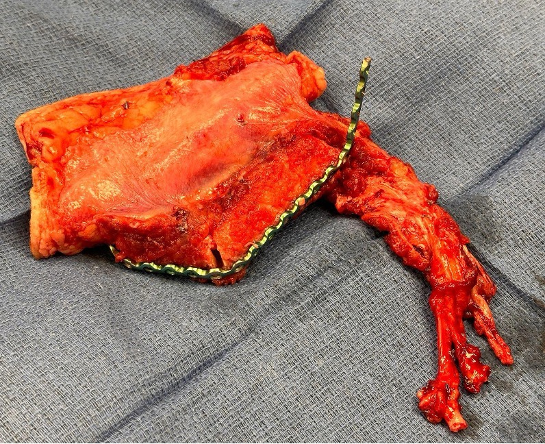 DTJournal1's tweet photo. Undiagnosed Factor V Leiden Presenting as Free Flap Thrombosis in Mandibular Reconstruction: A Case Report (Thornton, @kase_dmd , et al, 2025). https://t.co/5AdlGejPM5

#freeflap #thrombosis https://t.co/JbhMt1mSPy