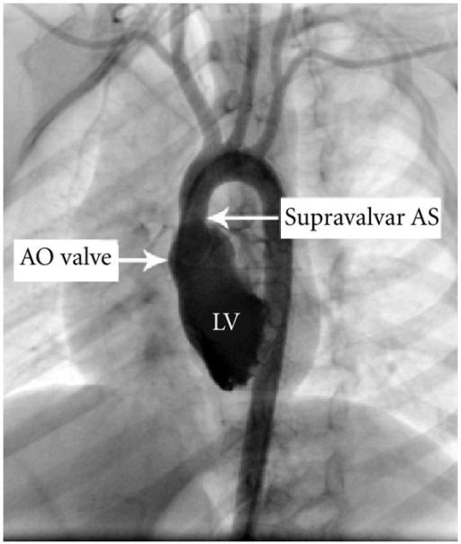 RitikaTuliMD's tweet photo. #CardioNugget 🫀

Supravalvular AS = jet direction matters

👉 Narrowing above aortic valve (classically in Williams syndrome)

👉 High-velocity jet hugs aortic wall → Coandă effect

👉 Jet preferentially enters brachiocephalic (right innominate) artery

⚡ Clinical clue:

RIGHT arm BP > LEFT arm BP (not coarctation!)

💡 Why?
More kinetic energy directed into right-sided arch vessels

#EchoBoards #Cardiology #Hemodynamics #CongenitalHeartDisease