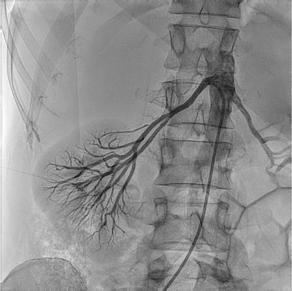 HMHemodinamica's tweet photo. Denervación renal con origen vertical de la renal derecha:el Simplicity Spyral no quiere ni asomarse a través del Sherpa MP😅.Solución: extensor coronario hasta las profundidades renales y… ¡objetivo conseguido!Mezclar juguetes de la estantería en la sala también salva el día!🧩 https://t.co/njaJedOfQd