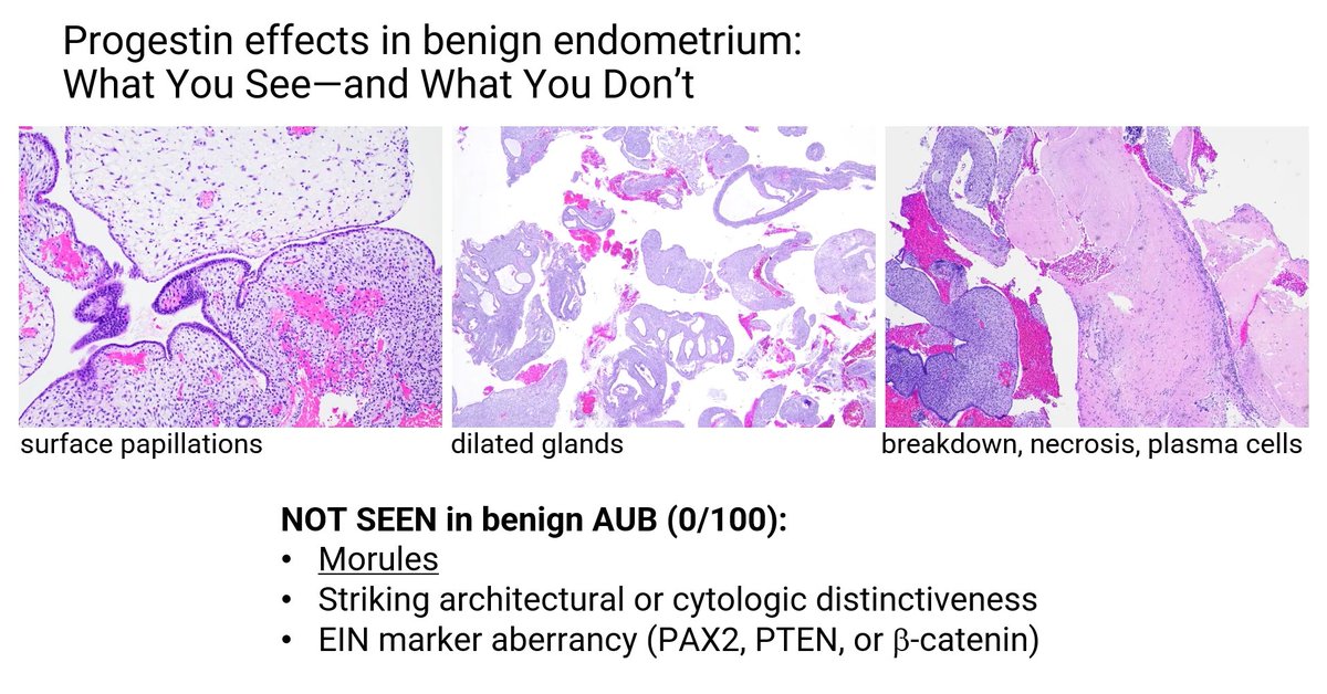 Janiranavarro's tweet image. Progestin effects in benign endometrium

What you see:
- Surface papillations
- Dilated glands
- Breakdown, necrosis, and plasma cells

Dr. Castrillon #USCAP2026 #pathology #PathX #PathTwitter #everydayGYN
