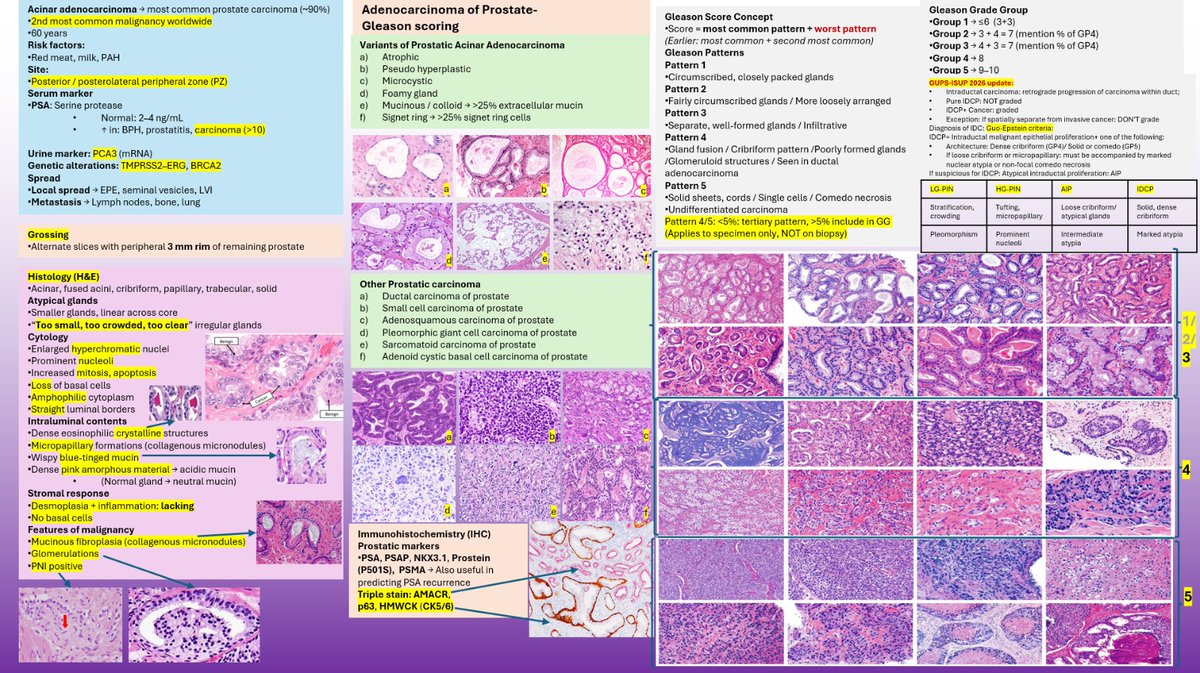 pathognosis22's tweet image. A brief summary on the carcinoma prostate. Hope this may help! #prostate #GUpath #residency #pathology #Gleason #ISUP #GUPS
