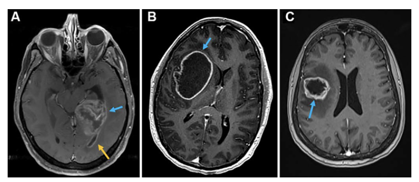 Journal of Neurosurgery tweet media