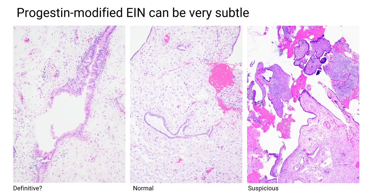Janiranavarro's tweet image. Progestin-modified EIN can be very subtle

Dr. Castrillon #USCAP2026 #pathology #PathX #PathTwitter #everydayGYN