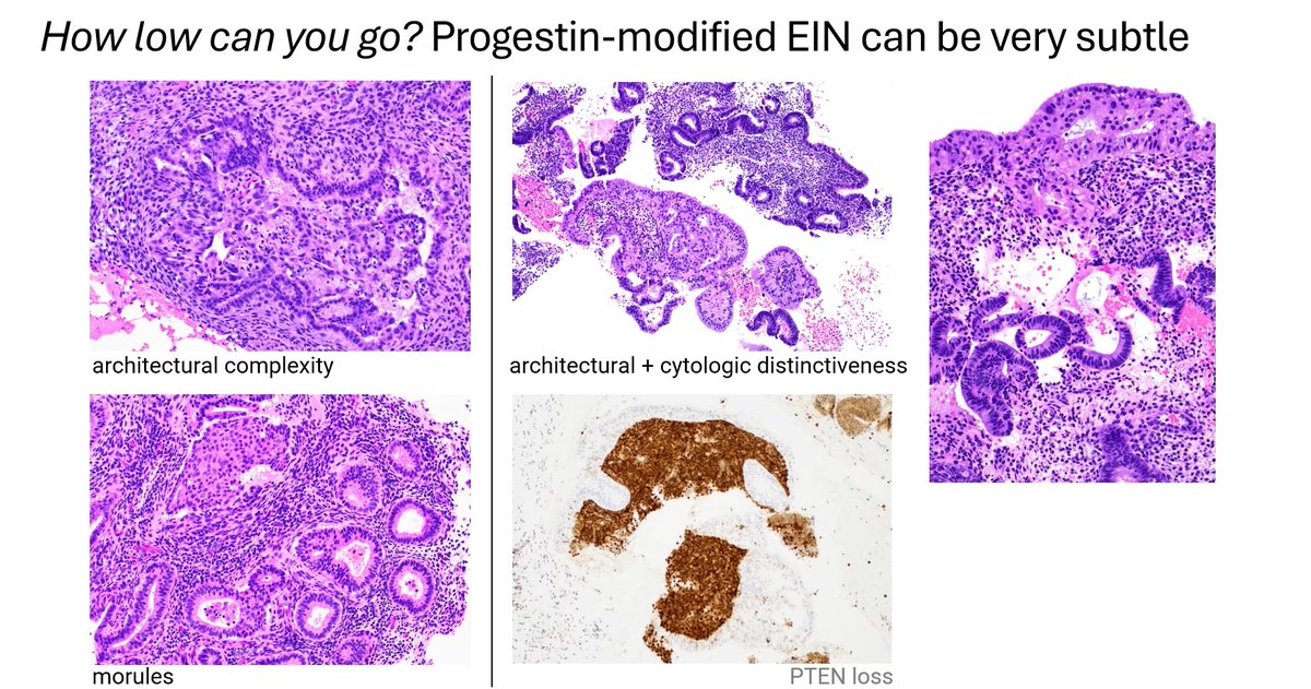 Janiranavarro's tweet image. Progestin-modified EIN can be very subtle

Dr. Castrillon #USCAP2026 #pathology #PathX #PathTwitter #everydayGYN