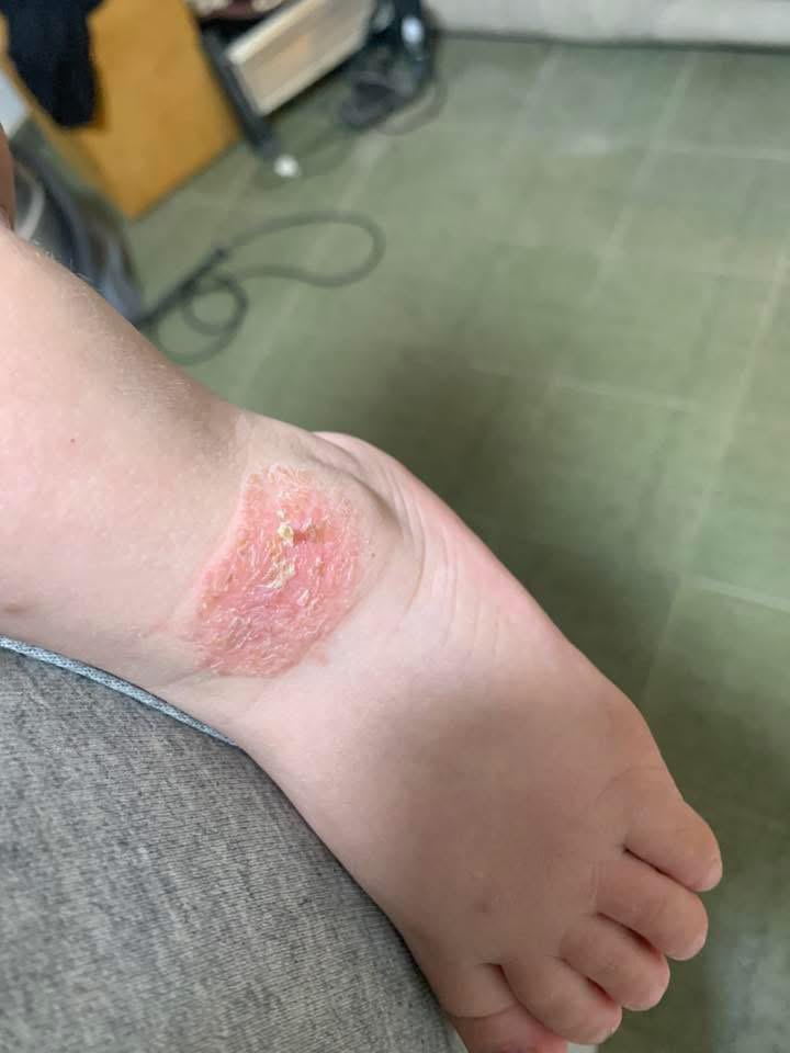 Dr_SaebGaza's tweet photo. The tumor turns into wounds The situation is getting worse and I am very worried Time is not on my child's side Any help will save my child 😭🍼

https://t.co/d015UU6KQ4 https://t.co/wDggBtPuxj