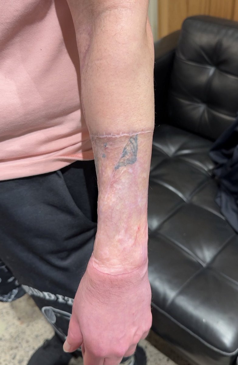 SilentKW's tweet image. Yer a wizard, Harry ⚡️ 

Covered up this skin graft with a Harry Potter tattoo