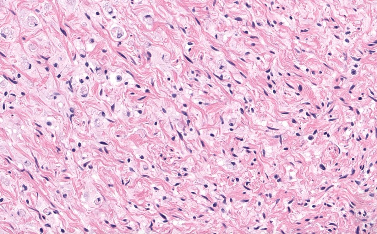 JMGardnerMD's tweet image. Deep soft tissue mass.
Answer ✅ youtube.com/watch?v=MPQhKl… 
WSI digital slide: kikoxp.com/posts/24672 
Gross pathology images: kikoxp.com/posts/24674
#pathology #pathologists #pathTwitter #dermpath #dermatology #dermatologia #dermtwitter #BSTpath