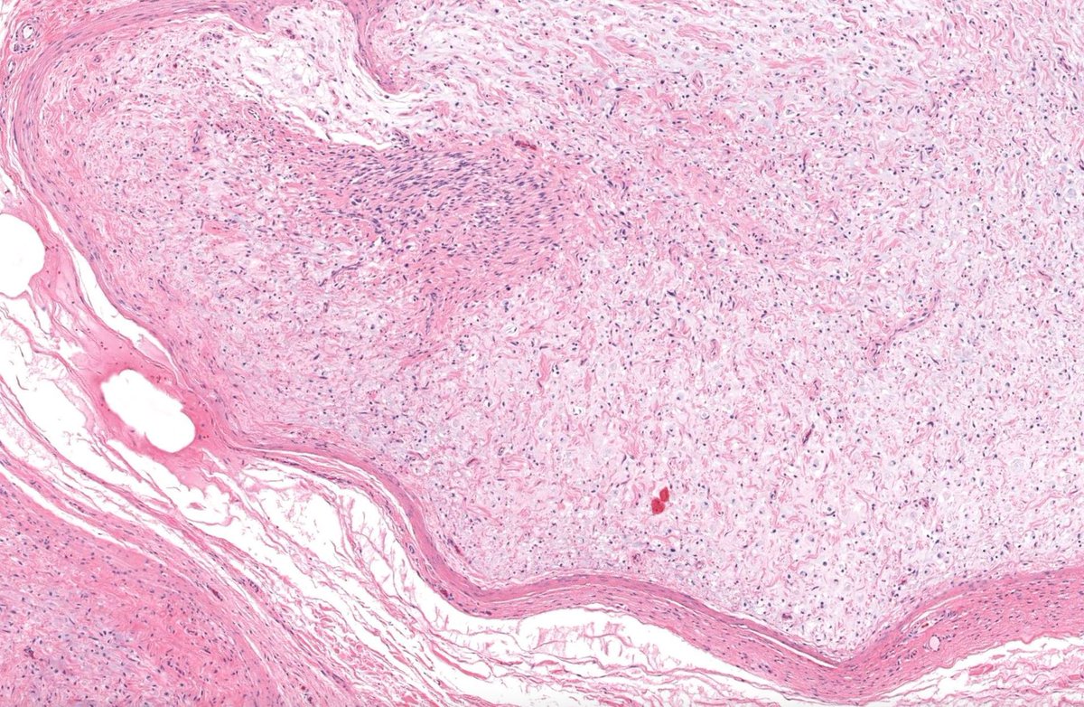 JMGardnerMD's tweet image. Deep soft tissue mass.
Answer ✅ youtube.com/watch?v=MPQhKl… 
WSI digital slide: kikoxp.com/posts/24672 
Gross pathology images: kikoxp.com/posts/24674
#pathology #pathologists #pathTwitter #dermpath #dermatology #dermatologia #dermtwitter #BSTpath