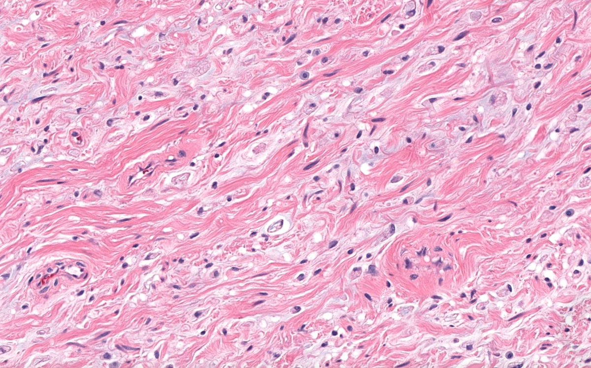 JMGardnerMD's tweet image. Deep soft tissue mass.
Answer ✅ youtube.com/watch?v=MPQhKl… 
WSI digital slide: kikoxp.com/posts/24672 
Gross pathology images: kikoxp.com/posts/24674
#pathology #pathologists #pathTwitter #dermpath #dermatology #dermatologia #dermtwitter #BSTpath