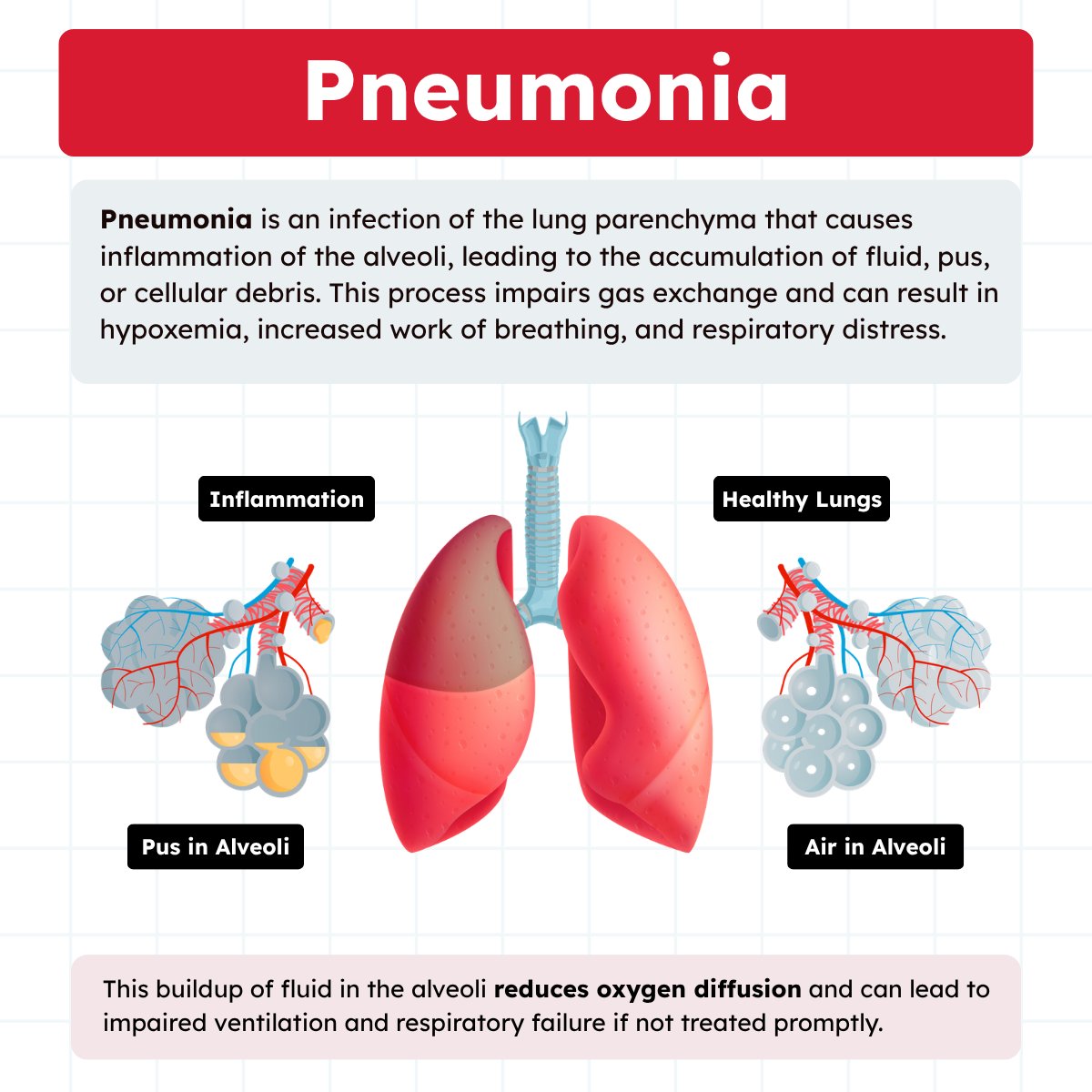 Pneumonia is an infection of the lung parenchyma that causes inflammation and fluid-filled alveoli, leading to impaired gas exchange and oxygenation. respiratorytherapyzone.com/pneumonia/?utm…