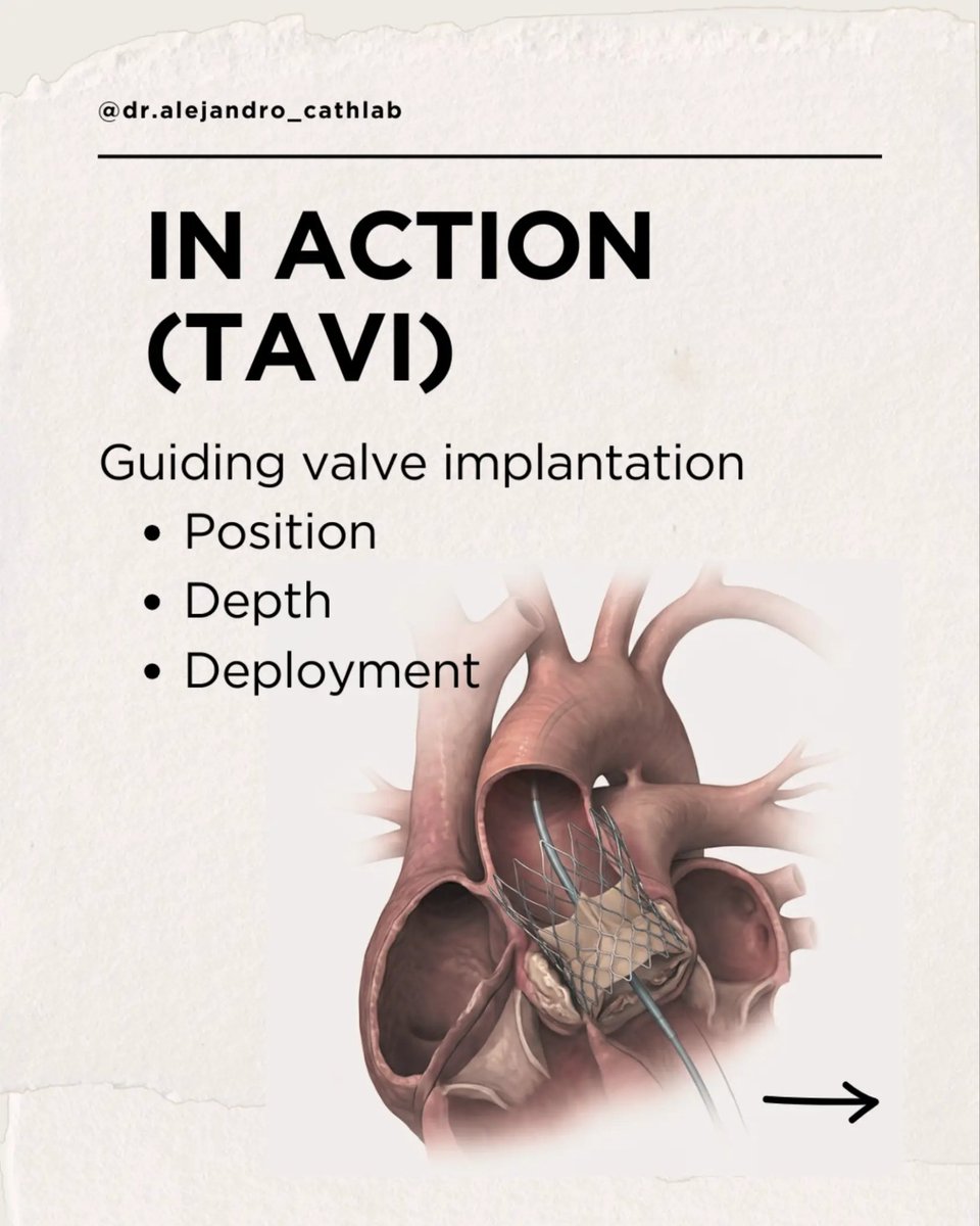 cardioalejandro's tweet image. 🔍 Each modality plays a distinct role:
• Fluoroscopy → real-time device navigation
• Echocardiography → soft tissue and valve interaction
• Cardiac CT → anatomical planning and sizing
#Cardiology #MedicalImaging