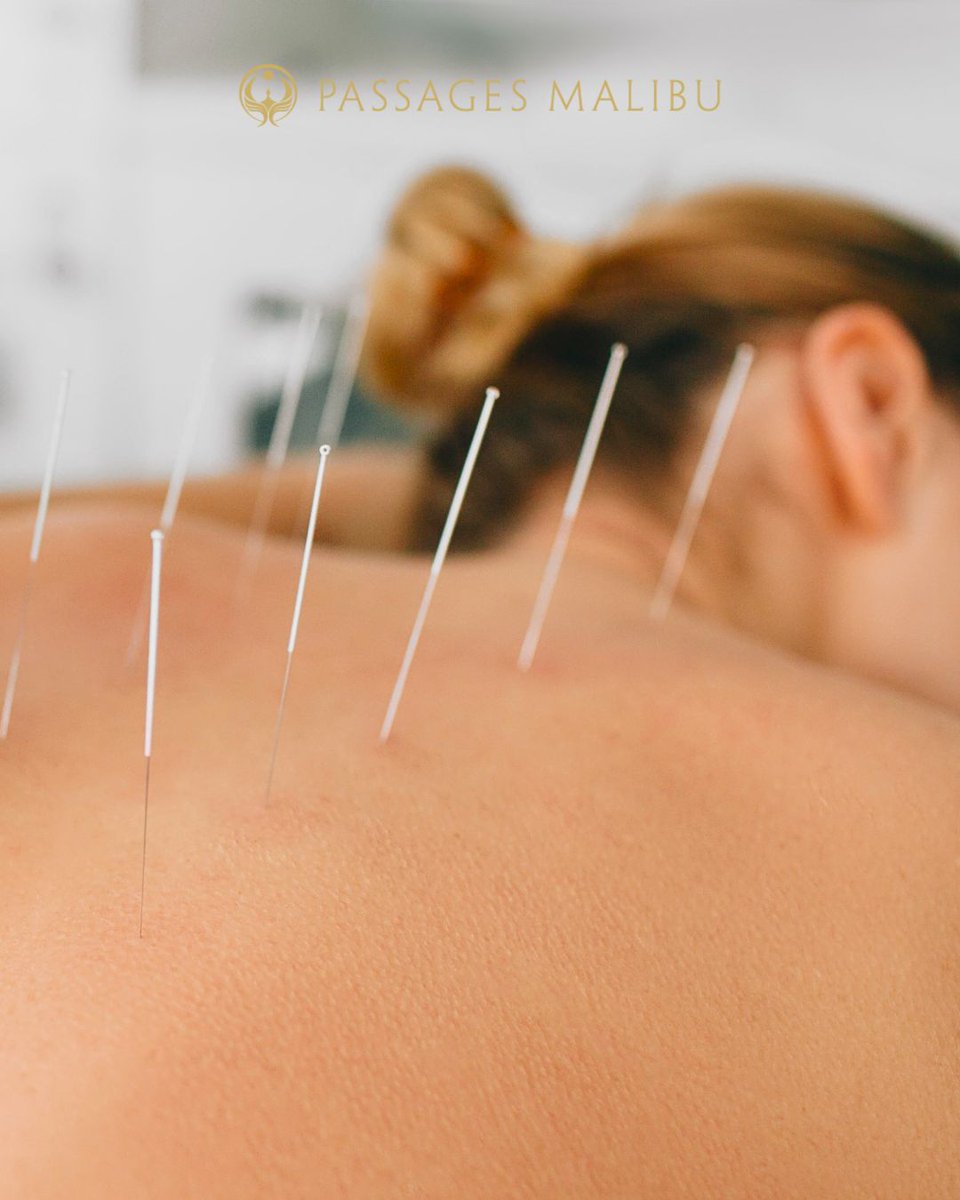 PassagesMalibu's tweet image. Acupuncture can be a powerful part of the healing process. Begin your healing journey today. 📞 866-436-2965 | ow.ly/obFw50YIvGb

#PassagesMalibu #Non12Step #LuxuryRehab #MalibuRehab #AddictionEndsHere