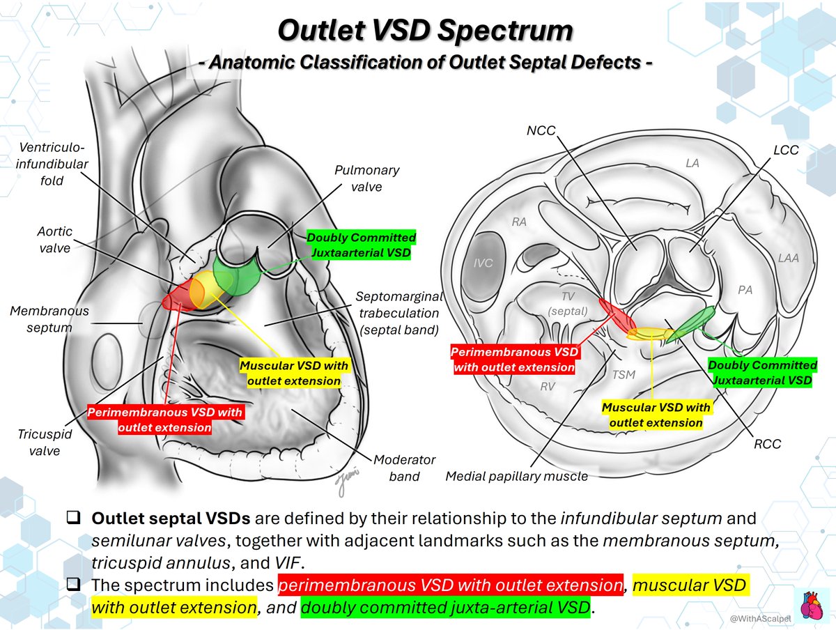 WithAScalpel's tweet photo. Outlet VSD Spectrum📝

👉Outlet septal VSDs include three main anatomic types: perimembranous with outlet extension, muscular with outlet extension, and doubly committed juxta-arterial VSD.
👉The short-axis echo view is especially helpful.