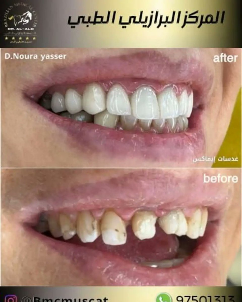المركز البرازيلي الطبي ( أسنان) مسقط 🇴🇲 tweet media