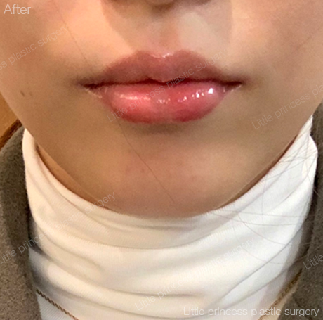 lpps_jp's tweet photo. 薄かった唇のコンプレックスがなくなり、ご満足いただけたとの口コミをありがとうございます！🥹💖

オリニコンジュ美容整形外科💖

LINE相談=@793jjgaa

#オリンコンジュ整形外科 #唇フィラー #リップフィラー #渡韓 #韓国整形 #口角ボトックス #フィラー #唇ヒアルロン酸 #唇ヒアル #ヒアルロン酸 https://t.co/33AjiqRQZZ