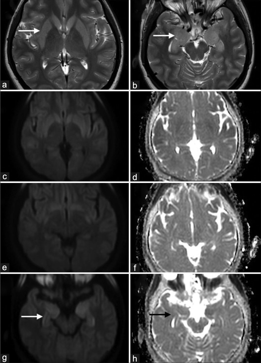 AnnIndAcadNeur's tweet image. Apkari et al reported that neuroimaging in FIRES evolves over time. Bilateral basal ganglia and hippocampal involvement occurs initially. The "claustrum sign" and cortical involvement is seen a few days later @neuro_ian #FIRES Link: 10.4103/aian.aian_823_23
