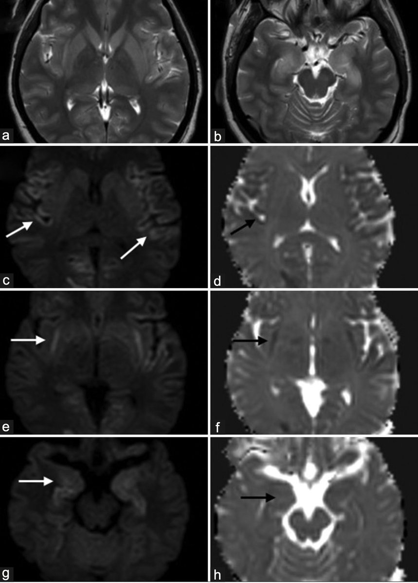 AnnIndAcadNeur's tweet image. Apkari et al reported that neuroimaging in FIRES evolves over time. Bilateral basal ganglia and hippocampal involvement occurs initially. The "claustrum sign" and cortical involvement is seen a few days later @neuro_ian #FIRES Link: 10.4103/aian.aian_823_23