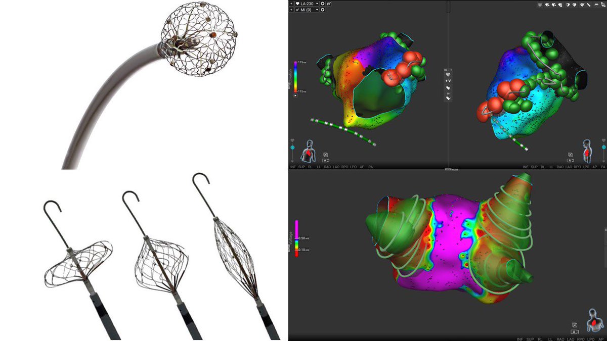 atwater_brett's tweet photo. This was a special week @ISHVnews EP. We performed our 2000th @Medtronic Sphere9 AF ablation and our 1st Sphere360 AF ablation. Thank you @MDT_Cardiac for bringing us technologies that transform our ability to treat #AFIB. https://t.co/ycs2vWzKqO
